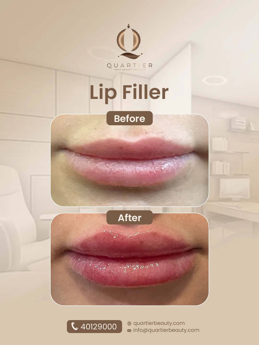 lip filler